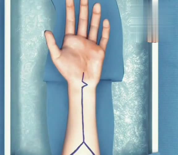 Красота и здоровье. Схематичный процесс отсечения руки. Хирургия.