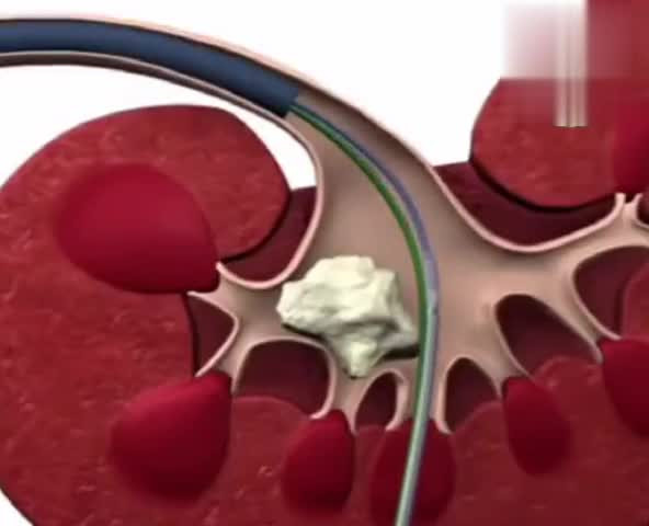 Красота и здоровье. Схематично. Удалить камни в почке.